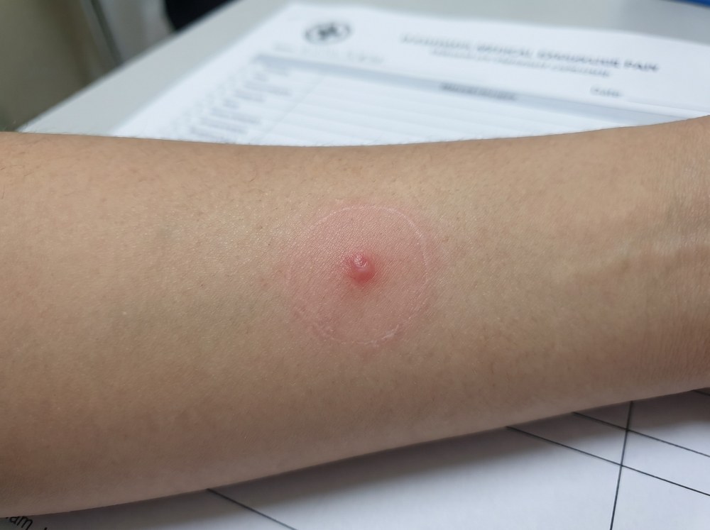 Close-up of a fresh brown prionid beetle pinch mark on skin showing a small red puncture with mild swelling and no blister